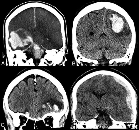 Brain Imaging Use And Findings In Covid 19 A Single Academic Center