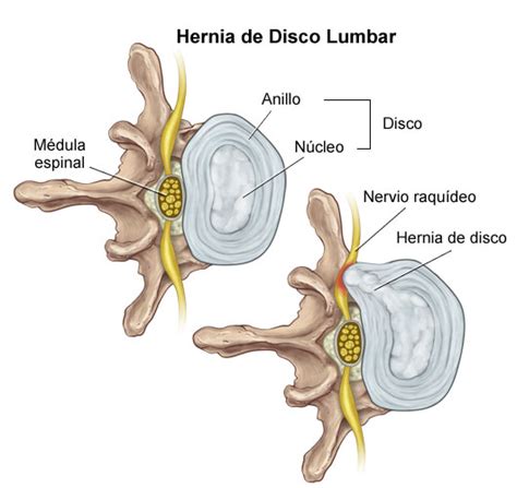 Hernia Discal Síntomas Y Tratamiento De La Hernia Discal Cervical Y