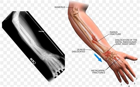 Thumb Arm Sprain X Ray Png 2028x1267px Thumb Arm Bone Fracture