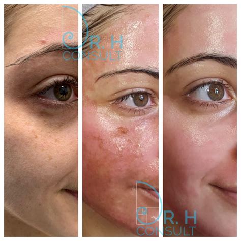 Sciton Halo And Micropeel London And Surrey Uk Dr H Consult