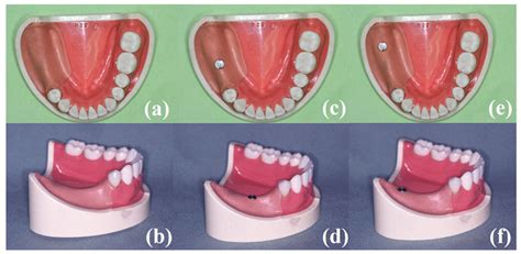 Images Of Simulated Kennedy Class Ii Partially Edentulous Mandibles