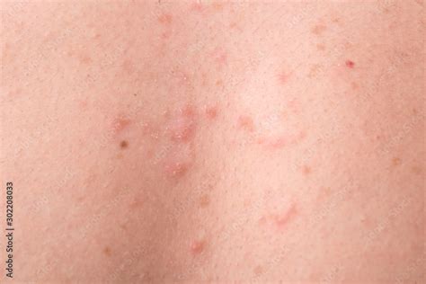 Streptococcal Skin Infection In The Form Of Rash Elements
