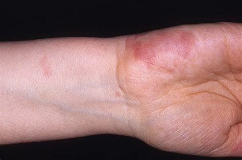 Allergic Vasculitis Of The Skin Treatment And Symptoms