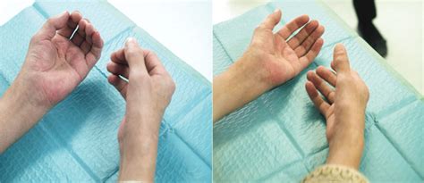 Palmar Fascitis And Polyarthritis As A Paraneoplastic Syndrome