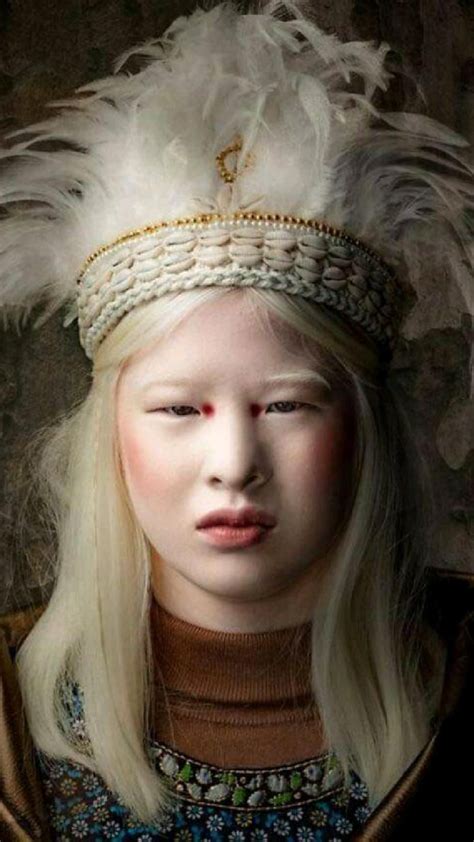 Abandoned As A Baby Due To Albinism Xueli Grew Up To Become A Vogue