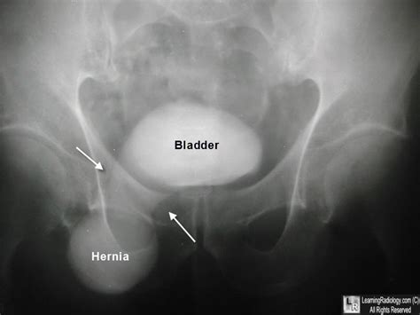 Learning Radiology Urinary Bladder Hernia