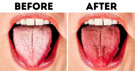 One must pour some water into the cloth. 10 Ways to Get Rid of White Tongue and Make It Healthier