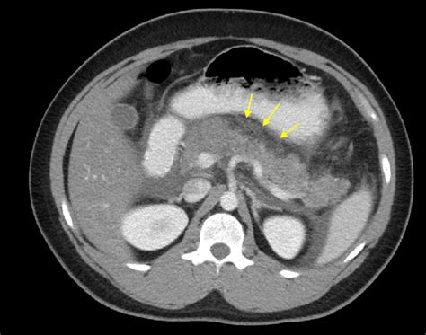 Cureus Acute Pancreatitis And Prognosticating Its Severity In Young
