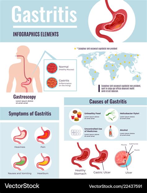 Gastritis Infographic Poster Royalty Free Vector Image