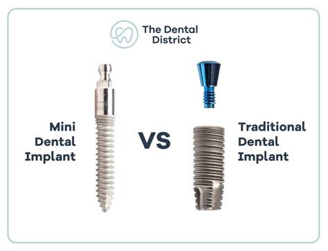 Mini Vs Traditional Dental Implants Which One Is Right For You
