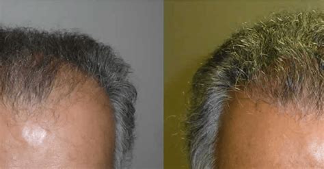 The Top Five Benefits Of A Hair Transplant Hair Facial Plastics
