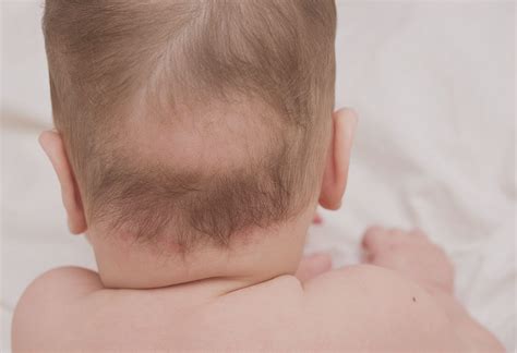 Scalp Problems In Kids Causes Symptoms And Treatment
