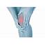 Top Three Most Common Knee Injuries  Body Helix