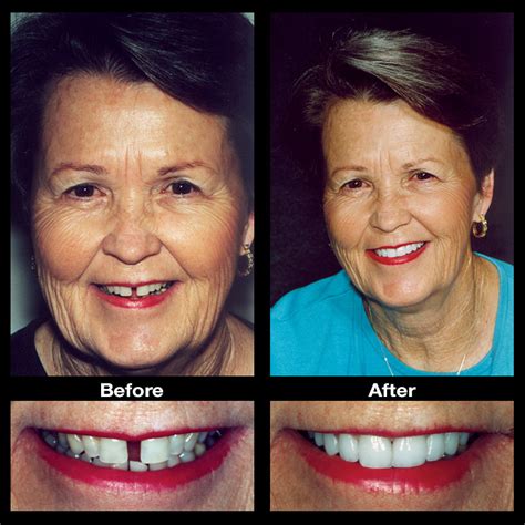 How to close gap teeth without braces or veneers. Fix Gap Spaces | Teeth Bands | Oppenheim Signature Smiles