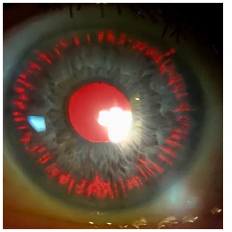 Pigmentary Glaucoma And Pigmentary Dispersion Syndrome Visivite
