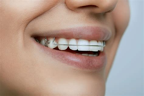 Ortodoncia Alcorcón Clínica Dental Neodent