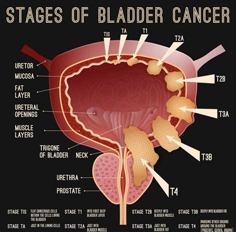 Bladder Cancer Causes Symptoms And Types Healthylivingly The Best