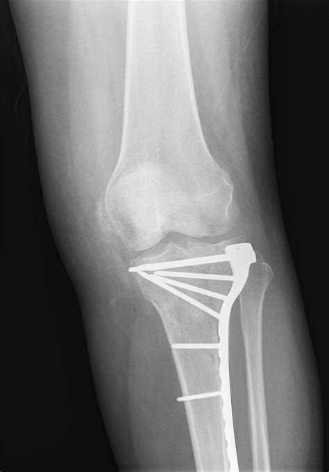 Tibial Plateau Fracture Classification Tibial Plateau Fracture