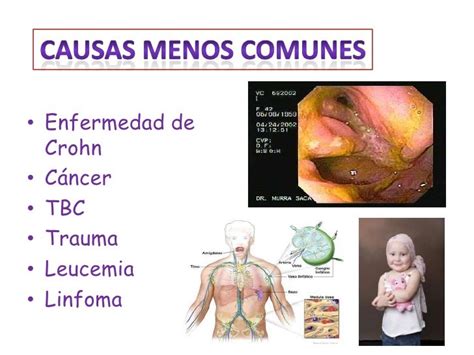 Absceso Perianal