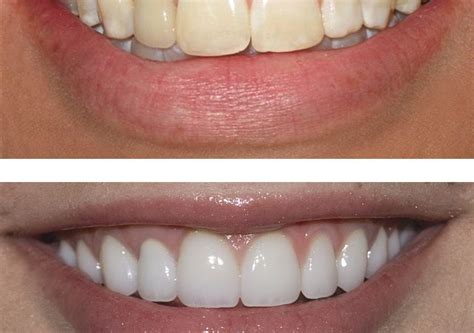 Teeth Cleaning Before And After