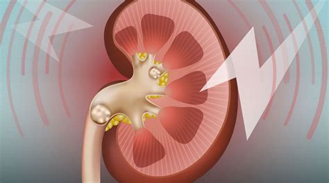 Uab News Kidney Stones A Marker Of Overall Kidney Health
