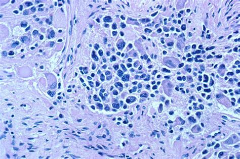 Neue Tumorbremse Beim Neuroblastom Entdeckt Krebs Nachrichten