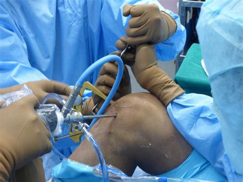 Acl Reconstruction Knee Arthroscopy Dr Sujit Jos Docjointsdr