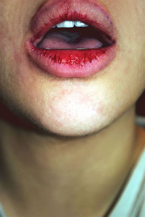 Wounded Lips Bocche Labbra Foto