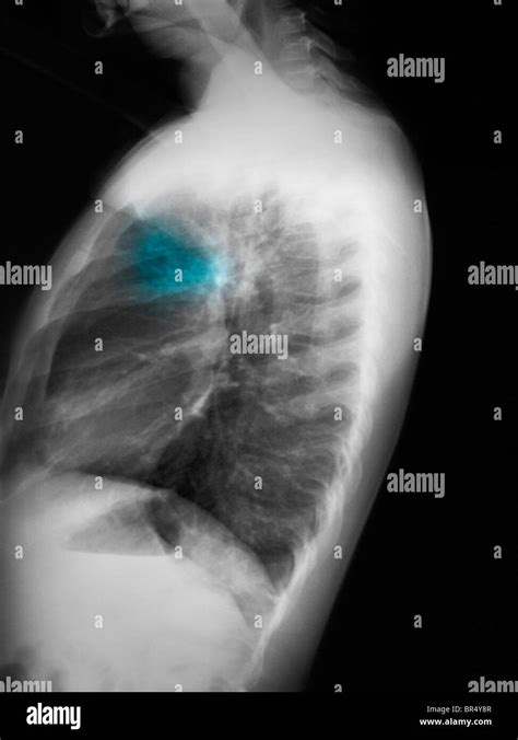 La radiografía de tórax de un niño de años mostrando un infiltrado en