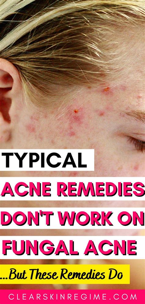 How To Clear Fungal Acne Aka Little Forehead Bumps Clearskinregime