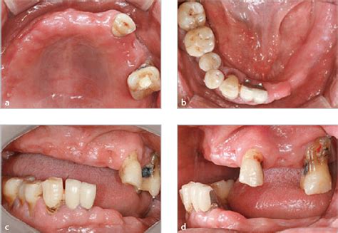 Restoration Of A Partially Edentulous Patient With An Implant Supported