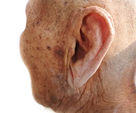 Ear Cancer — Texas Ear Clinic