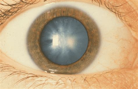 Three Things Patients Should Know About Cataracts Friedberg Eye