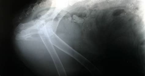 Patients Set To Share 250m In Johnson And Johnson Hip Implant Case The