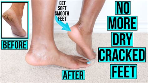 Whilst the removal of corns is best left to a doctor, cracked a callus is where a piece of skin on your foot has thickened or hardened because of friction. How to Get Rid of Dry Cracked Feet FAST & NATURALLY | AT ...