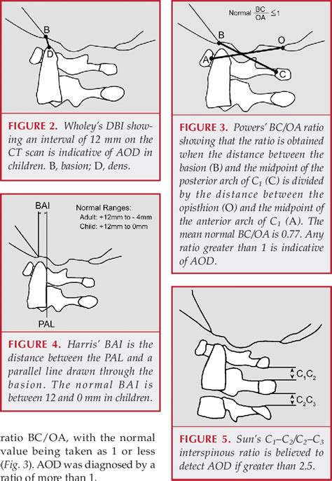 Figure 6 From Atlanto‐occipital Dislocation—part 2 The Clinical Use Of