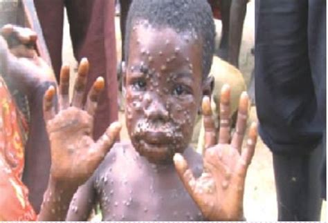 It is called monkeypox because it was first identified in laboratory monkeys. Panic as Monkeypox Hits Lagos, Others - Nigerian ...
