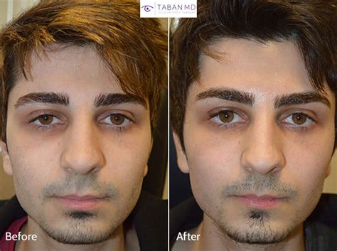 Eyelid Ptosis Before And After Gallery Taban Md