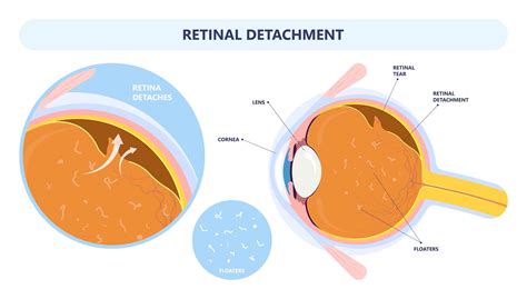 Retinal Detachment Vision