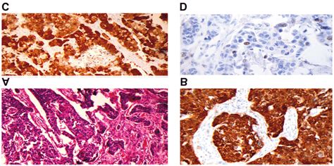 Microscopical Images Showing P16 Immunohistochemical Expression A