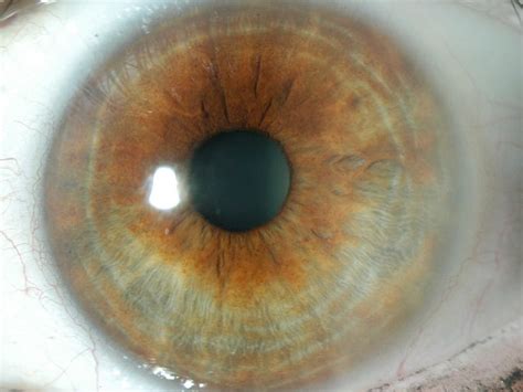 Medscape Log In Corneal Abrasion Eye Health Corneal
