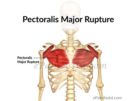 This pain is usually felt at the front of the armpit and is sometimes felt . Pectoralis Major Rupture: Treatment, Exercise, Prevention ...