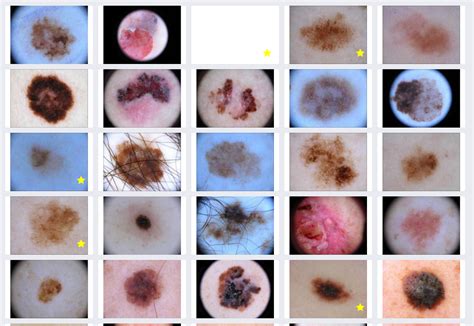 Skin Cancer Moles Chart