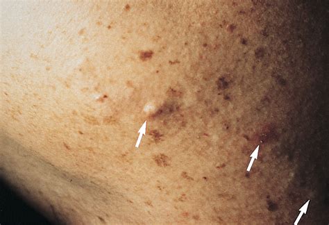 Painful Linear Nodules Jama Dermatology Jama Network
