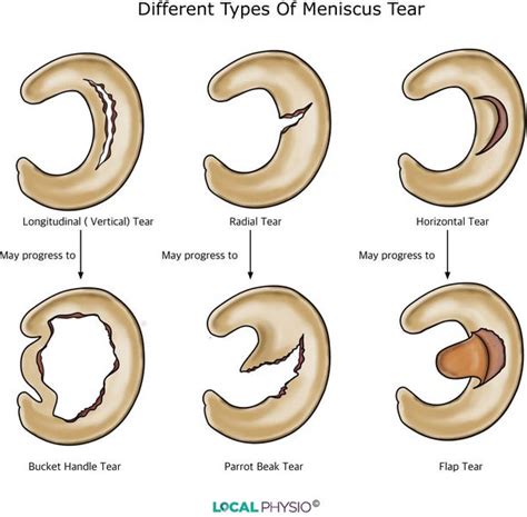 Meniscus Tears Sports Medicine Doctor Mesa Az Orthopedic Surgeon
