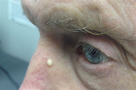 Derm Dx White Papule On The Nose Clinical Advisor