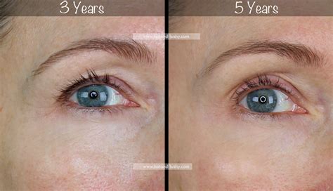 5 Year Retin A Results Before And After For Wrinkles And Anti Aging