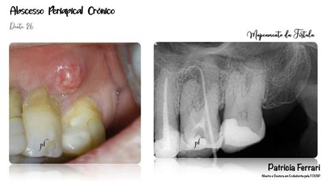 Abscesso Periapical Crônico Em Dente Com Trinca Patricia Ferrari
