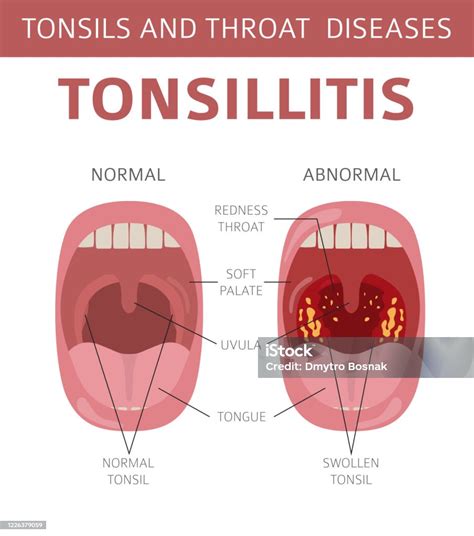 Amandelen En Keelziekten Tonsillitis Symptomen Behandeling Icoon Set