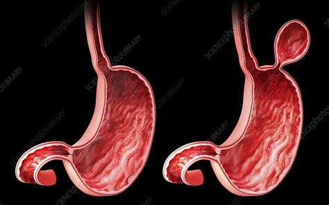 Human Stomach With Hernia Artwork Stock Image F0087048 Science